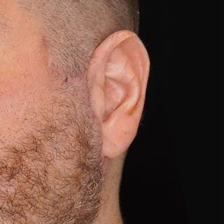 Deep Plane Facelift Before & After Gallery - Patient 195119 - Image 4