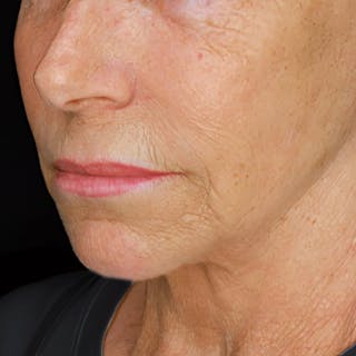 Deep Plane Facelift Before & After Gallery - Patient 209850 - Image 2