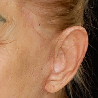 Deep Plane Facelift Before & After Gallery - Patient 209850 - Image 4