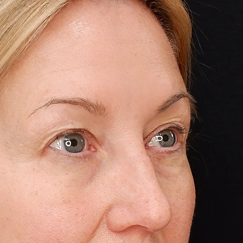 Upper Blepharoplasty Before & After Gallery - Patient 403173 - Image 3