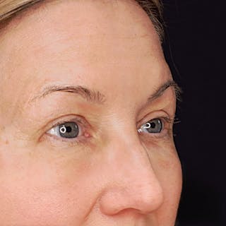 Upper Blepharoplasty Before & After Gallery - Patient 403173 - Image 4