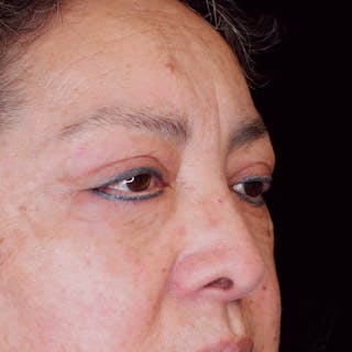 Upper Blepharoplasty Before & After Gallery - Patient 551786 - Image 4