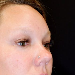 Lower Blepharoplasty Before & After Gallery - Patient 111362 - Image 4