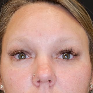 Lower Blepharoplasty Before & After Gallery - Patient 111362 - Image 2