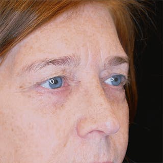 Lower Blepharoplasty Before & After Gallery - Patient 359365 - Image 4
