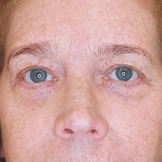 Lower Blepharoplasty Before & After Gallery - Patient 359365 - Image 2