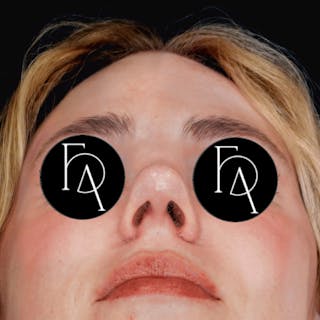 Rhinoplasty Before & After Gallery - Patient 185436 - Image 4