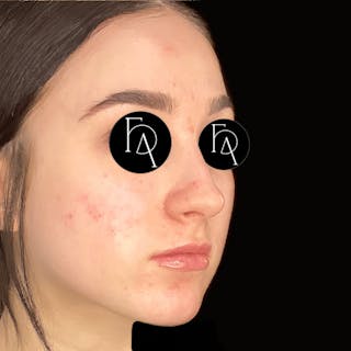 Rhinoplasty Before & After Gallery - Patient 381970 - Image 2