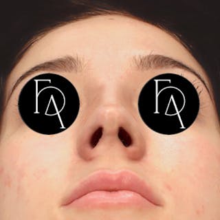 Rhinoplasty Before & After Gallery - Patient 381970 - Image 4