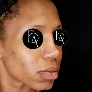 Rhinoplasty Before & After Gallery - Patient 311806 - Image 2