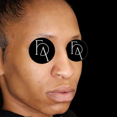 Rhinoplasty Before & After Gallery - Patient 311806 - Image 1