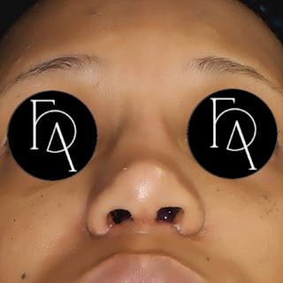 Rhinoplasty Before & After Gallery - Patient 311806 - Image 4