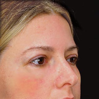 Upper Blepharoplasty Before & After Gallery - Patient 303788 - Image 4
