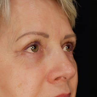 Quad Blepharoplasty Before & After Gallery - Patient 309280 - Image 4