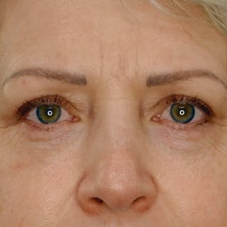 Quad Blepharoplasty Before & After Gallery - Patient 309280 - Image 2