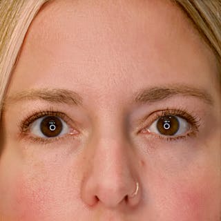 Upper Blepharoplasty Before & After Gallery - Patient 303788 - Image 2