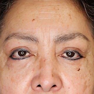 Upper Blepharoplasty Before & After Gallery - Patient 551786 - Image 2