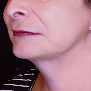 Deep Plane Facelift Before & After Gallery - Patient 178243 - Image 2