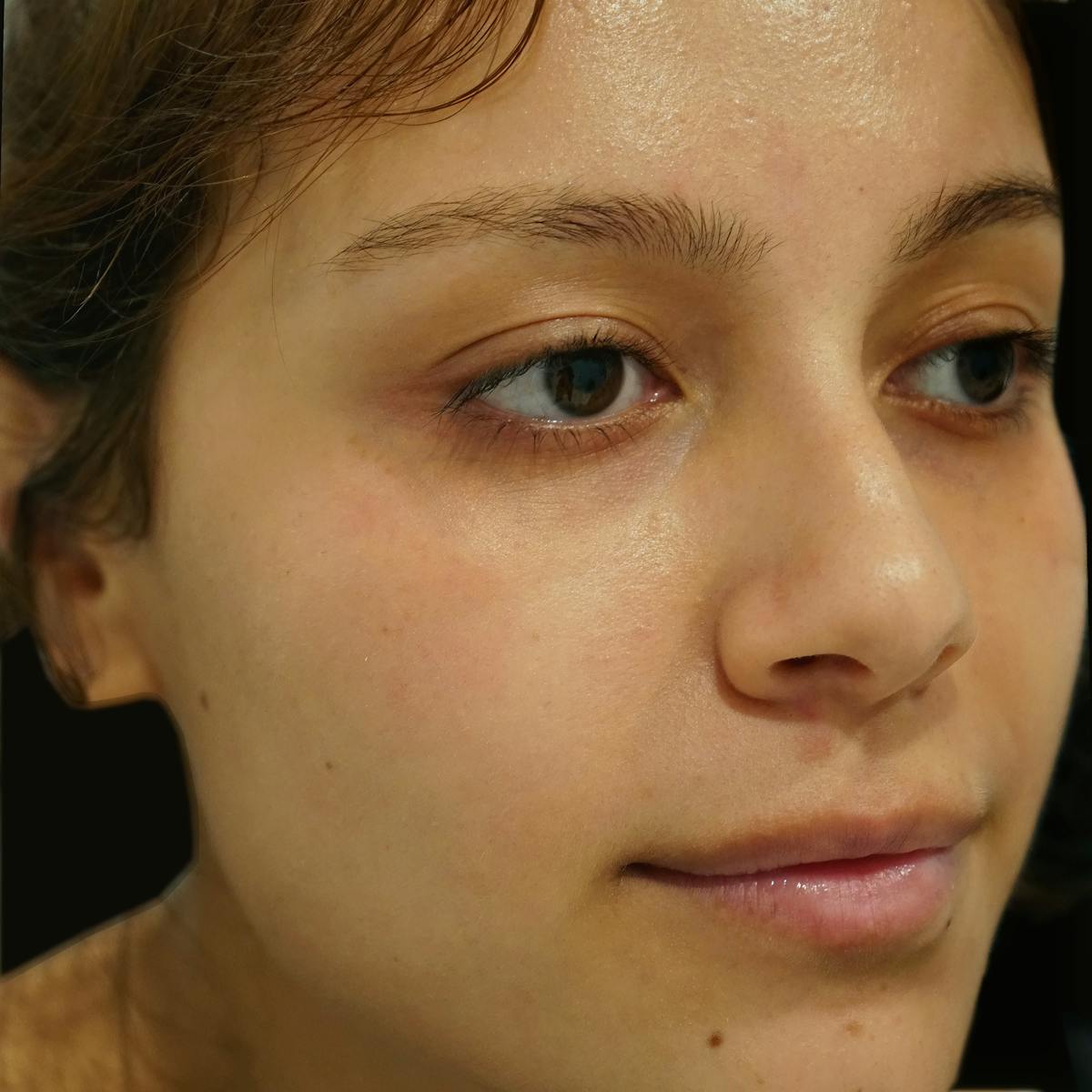 Fillers Before & After Gallery - Patient 582075 - Image 3