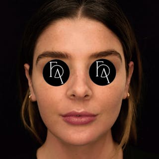 Submental Liposuction Before & After Gallery - Patient 395105 - Image 6