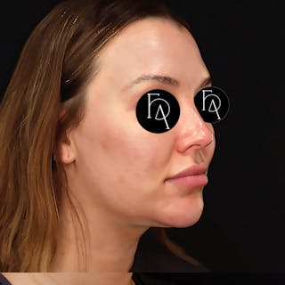 Submental Liposuction Before & After Gallery - Patient 981263 - Image 4