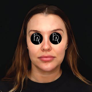 Submental Liposuction Before & After Gallery - Patient 981263 - Image 6