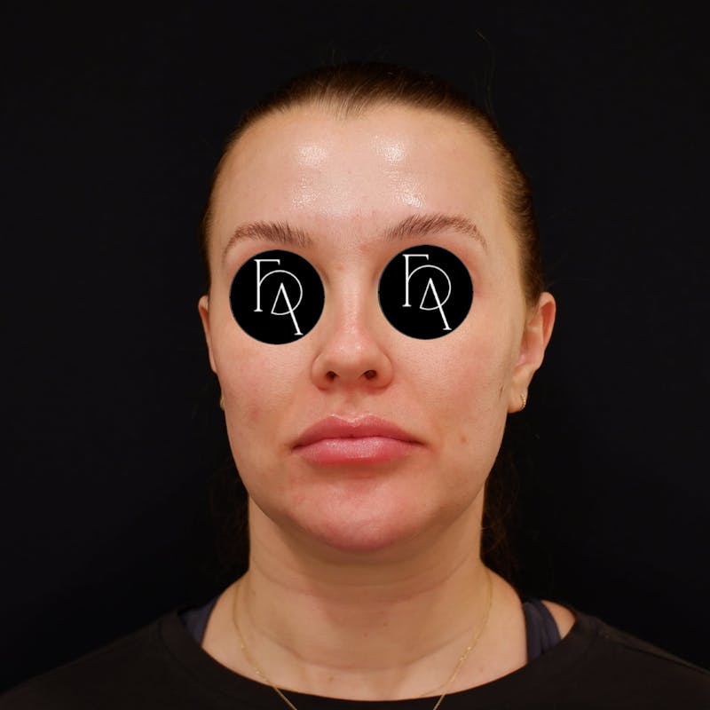 Submental Liposuction Before & After Gallery - Patient 981263 - Image 5