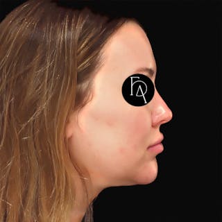 Submental Liposuction Before & After Gallery - Patient 981263 - Image 2