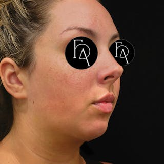 Submental Liposuction Before & After Gallery - Patient 189492 - Image 4