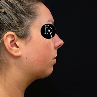 Submental Liposuction Before & After Gallery - Patient 189492 - Image 2