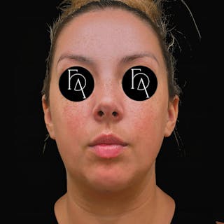 Submental Liposuction Before & After Gallery - Patient 189492 - Image 6