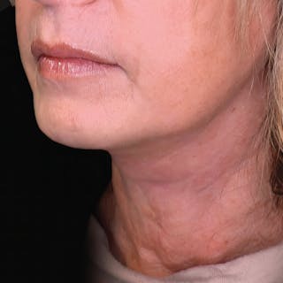 Platysmaplasty Before & After Gallery - Patient 146025 - Image 2