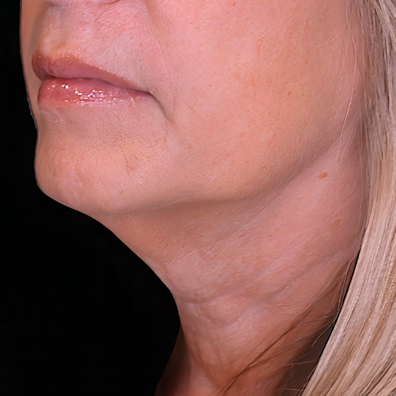 Platysmaplasty Before & After Gallery - Patient 146025 - Image 1
