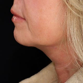 Platysmaplasty Before & After Gallery - Patient 146025 - Image 4