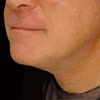 Platysmaplasty Before & After Gallery - Patient 133786 - Image 2