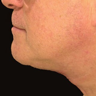 Platysmaplasty Before & After Gallery - Patient 133786 - Image 4