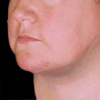 Neck Lift Before & After Gallery - Patient 162568 - Image 2