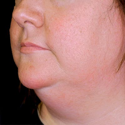 Neck Lift Before & After Gallery - Patient 162568 - Image 1