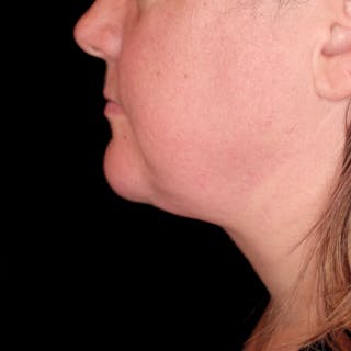 Neck Lift Before & After Gallery - Patient 162568 - Image 4