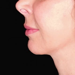 Neck Lift Before & After Gallery - Patient 950993 - Image 4