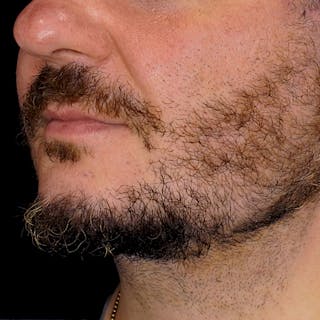 Neck Lift Before & After Gallery - Patient 153832 - Image 2