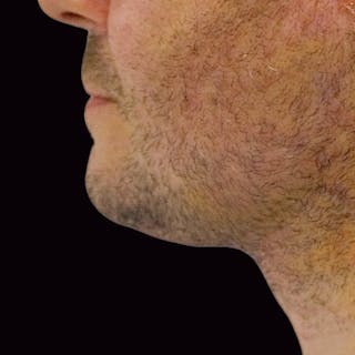 Neck Lift Before & After Gallery - Patient 153832 - Image 4