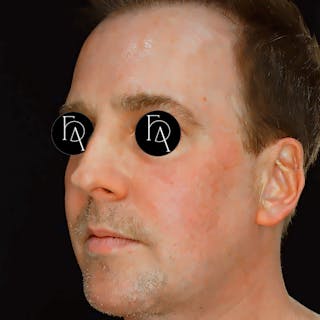 Facial Fat Grafting Before & After Gallery - Patient 786355 - Image 2