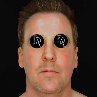 Facial Fat Grafting Before & After Gallery - Patient 786355 - Image 4