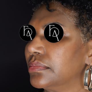 Facial Fat Grafting Before & After Gallery - Patient 329848 - Image 2