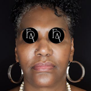 Facial Fat Grafting Before & After Gallery - Patient 329848 - Image 4