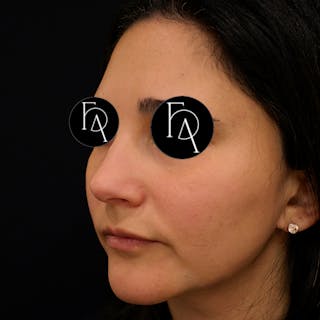 Facial Fat Grafting Before & After Gallery - Patient 240344 - Image 2