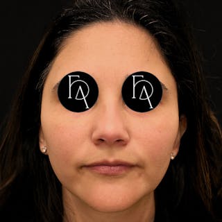 Facial Fat Grafting Before & After Gallery - Patient 240344 - Image 4