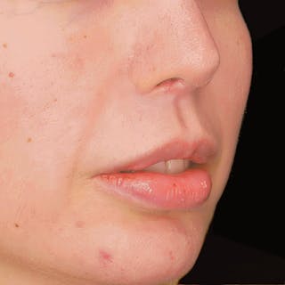 Lip Lift Before & After Gallery - Patient 397898 - Image 4