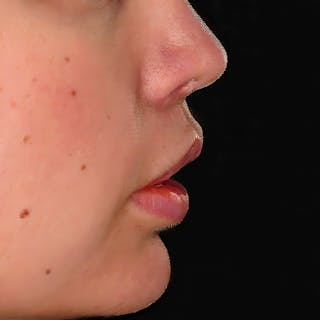 Lip Lift Before & After Gallery - Patient 397898 - Image 6